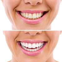 Blanqueamientos dentales